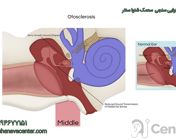 علائم بیماری اتواسکلروز