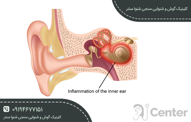 عفونت گوش میانی