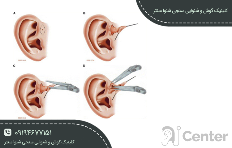 انواع راه‌های درمان کیست گوش
