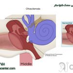 علائم بیماری اتواسکلروز