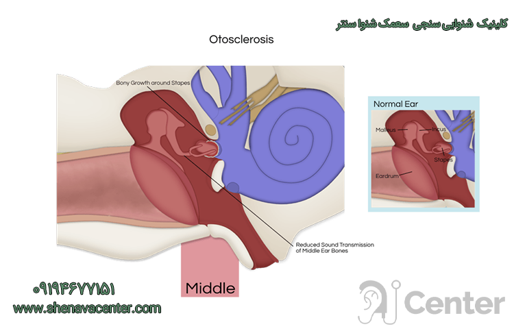 علائم بیماری اتواسکلروز