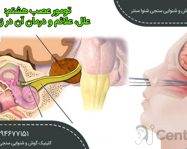 تومور عصب هشتم در زنجان
