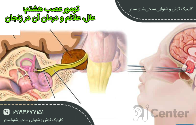 تومور عصب هشتم در زنجان