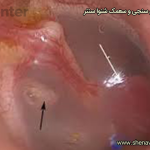 تومور گلوموس