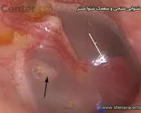 تومور گلوموس