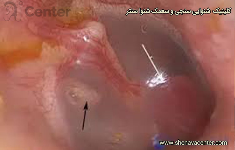 تومور گلوموس