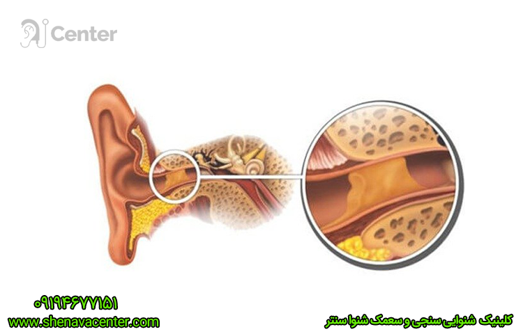 راه‌های پیشگیری از گرفتگی گوش