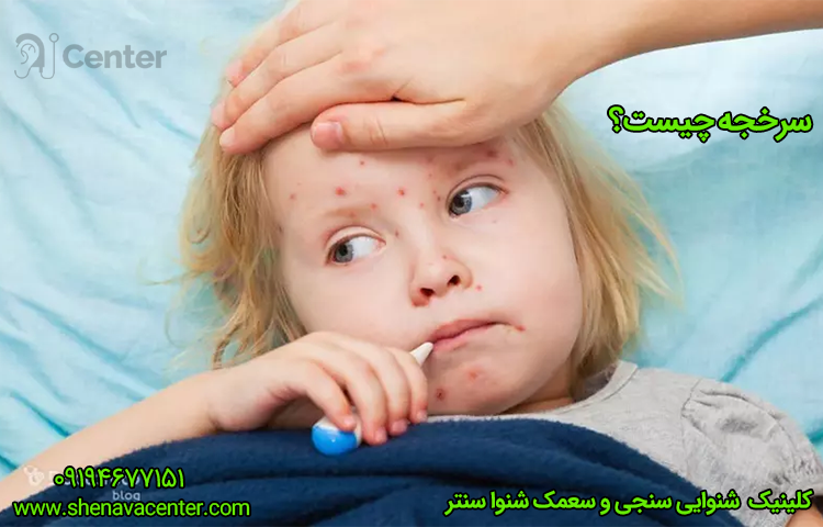 سرخجه چیست و چگونه در زنجان تشخیص داده می‌شود؟