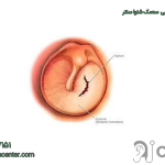 پارگی پرده گوش زنجان