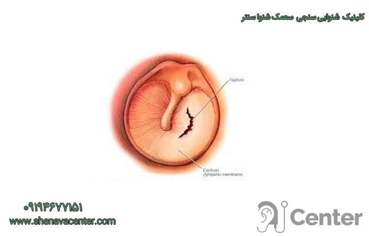پارگی پرده گوش زنجان