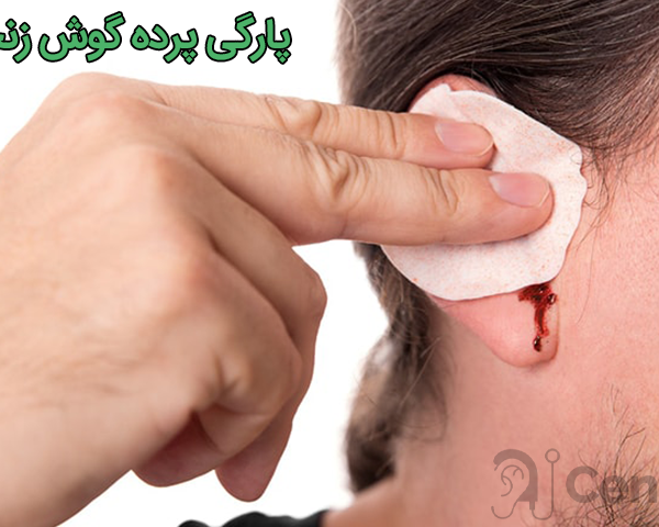 پارگی پرده گوش زنجان