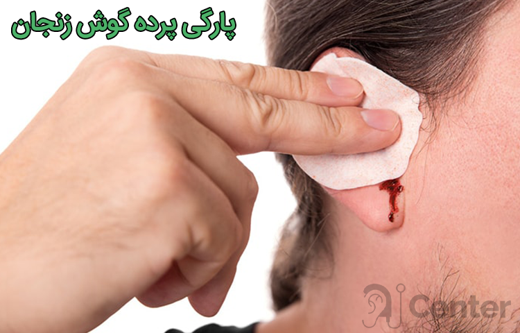 پارگی پرده گوش زنجان
